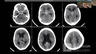 1st Tumor Board of the Skull Base Committee of WFNS  Identification [upl. by Lesya]