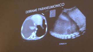 IMAGENOLOGÍA EN LA NEUMONIA COMPLICADA  DR JAVIER LOPEZ BUENO [upl. by Ocsic]