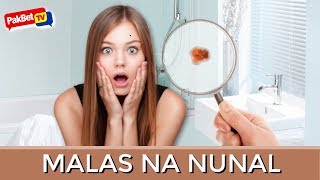 5 MALAS na NUNAL sa Mukha – MAG INGAT KA [upl. by Quintina]