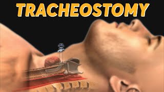 quotUnderstanding Tracheostomy A Comprehensive Animated Guide by Dr Vyshnaviquot [upl. by Brinkema]