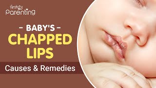 Chapped Lips in Babies  Causes and Treatment [upl. by Akiwak]