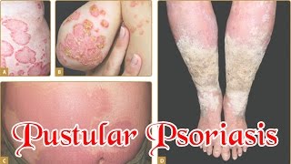 Pustular Psoriasis  How To Treat Pustular Psoriasis Naturally [upl. by Adamo]