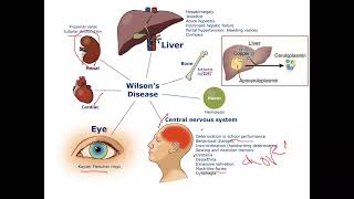 pediatric Hepatology Wilsons Disease [upl. by Malcah]