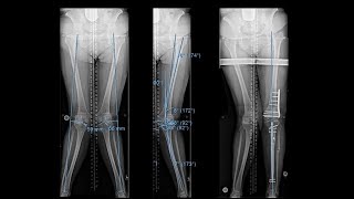 Surgical Realignment Knock Knee Correction [upl. by Hildick]