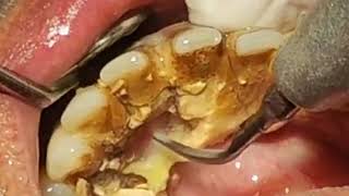 How to remove TARTAR from Teeth  Tartar removal before and after [upl. by Ecinaj]