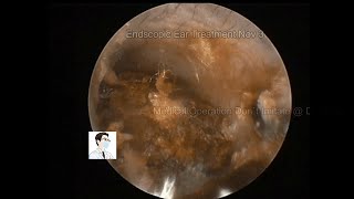 Review of cholesteatoma and ear wax removal9mins20221103 [upl. by Ragse]