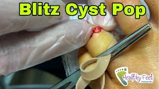 Popping a Ganglion Cyst [upl. by Adnohsed]