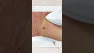 Big Cystic Acne Blackheads Extraction Blackheads amp Milia Whiteheads Removal Pimple Popping shorts [upl. by Egnalos255]