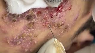 BEST BLACKHEAD AND WHITEHEAD REMOVAL SEVERE ACNE TREATMENT  SATISFYING AND RELAXING VIDEO [upl. by Sang]