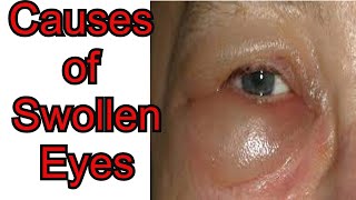 How to Cure Swollen Eyes Overnight  You Wont Believe The Results [upl. by Leseil211]