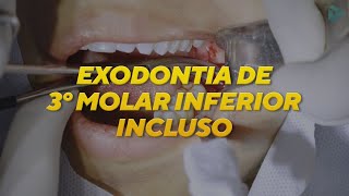 EXODONTIA DE TERCEIRO MOLAR INCLUSO  CIRURGIA [upl. by Alocin]