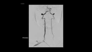 Cerebral angiography 14 [upl. by Ermin]