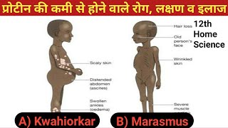 प्रोटीन की कमी से होने वाले रोग लक्षण व इलाज  Kwashiorkor disease  Marasmus disease [upl. by Bjork]