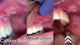 Canker sores [upl. by Yarvis]