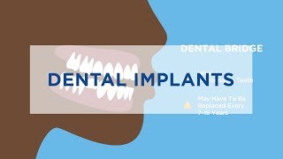 Dental Implants vs Dentures 15 [upl. by Notsae]