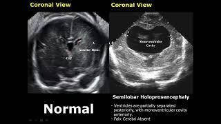 Fetal Brain Ultrasound Normal Vs Abnormal Image Appearances Comparison  Fetal Brain Pathologies USG [upl. by Airt]