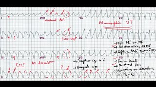 ECG quiz 4 Ventricular tachycardia or SVT with aberrancy [upl. by Yras21]