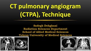 MedImag Optimization of Techniques in CT pulmonary angiogram Part 2 [upl. by Jeuz]