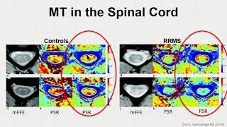 ISMRM MR Academy  Quantitative Magnetization Transfer Imaging for Characterizing Pathology [upl. by Hgieleak911]