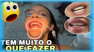 FINALMENTE FUI NO DENTISTAOLHA COMO FOI [upl. by Bella]