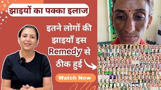 10 साल पुरानी झाइयों को कैसे इस Remedy से 3 महीने में ठीक किया  Pigmentation Melasma Remedy [upl. by Birck625]