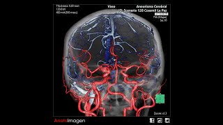 AngioTomografía Cerebral  Reconstrucción con Software de Sustracción Digital Extracción de Vasos [upl. by Carrington]