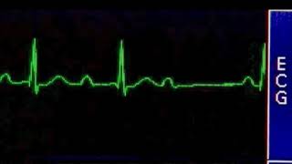 Second Degree Type I AV Block  Bloqueo de Segundo Grado AV  ECG [upl. by Errised210]