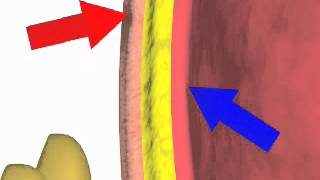 Paracentesis Procedure Ascites Tap in detail [upl. by Noevad]