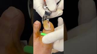 Temporary Fungus Nail Removal shorts [upl. by Adamsen]