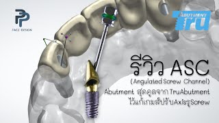 รีวิว ASC Angulated Screw Channel Abutment สุดคูลจาก TruAbutment ไว้แก้เกมส์ปรับAxisรูScrew [upl. by Strephonn72]