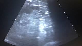 Renal lithiasis Ultrasound Litiasis renal Ecografia [upl. by Ohara]