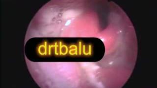 Acute epiglotititis [upl. by Asiel]