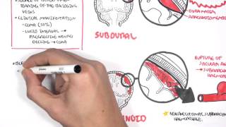 Intracranial Haemorrhage Types signs and symptoms [upl. by Nored965]