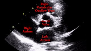 Aortic Valve  Parasternal Short Axis [upl. by Conias]