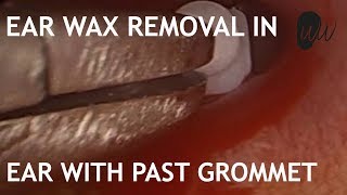 Ear Wax Removal in Ear with past Grommet  368 [upl. by Epilihp11]