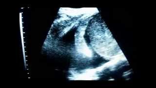 Ultrasound diagnosis of hemothorax [upl. by Deehsar]