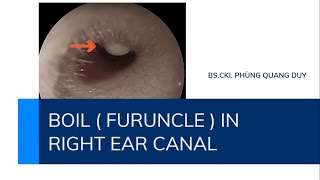 BOIL  FURUNCLE  IN RIGHT EAR CANAL NHỌT ỐNG TAI PHẢI [upl. by Elsbeth]