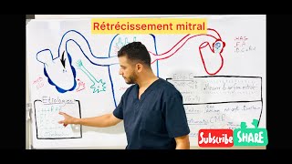 Rétrécissement mitral [upl. by Bibeau169]