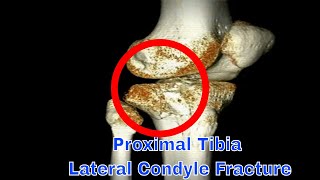 Proximal Tibia Lateral Condyle Fracture [upl. by Ierbua]