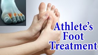 Athletes Foot Fungal Infection Home Treatment  5 Ways to Treat amp Avoid Athletes Foot at Home [upl. by Ikkim]