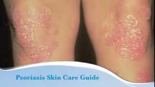 Psoriasis skin care guide [upl. by Lateh504]