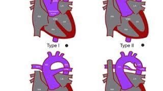 Truncus arteriosis [upl. by Lienet368]