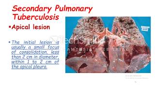 Secondary Pulmonary Tuberculosis [upl. by Enelak96]