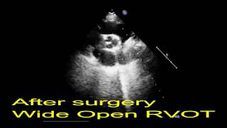 Echocardiogram of Pulmonary valve endocarditis before and after surgery [upl. by Laurentium]