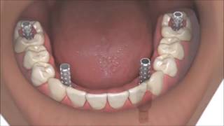 AllOn4 Dental Implants Coventry Best Same Day Full Whole Mouth Teeth Implants At Verum Dentists [upl. by Htepsle622]