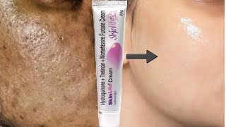 SkinLite Cream  remove pigmentation dark spots Acne marks pimple marks [upl. by Bette151]