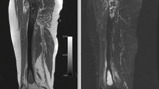 Chondrosarcoma Xray images with explanation [upl. by Castle]