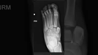 Lisfranc fracture dislocation Radiographs xray meded podiatry orthopedics [upl. by Navarro654]