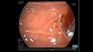 Primary Sclerosing Cholangitis and Brush Cytology Sampling [upl. by Peyter]