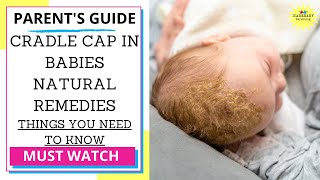 Cradle Cap in babies  Remedies [upl. by Calypso]